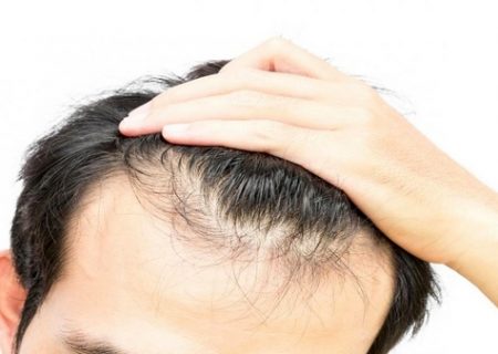 دلایل سفید شدن مو‌ در سنین جوانی و راهکار درمان آن